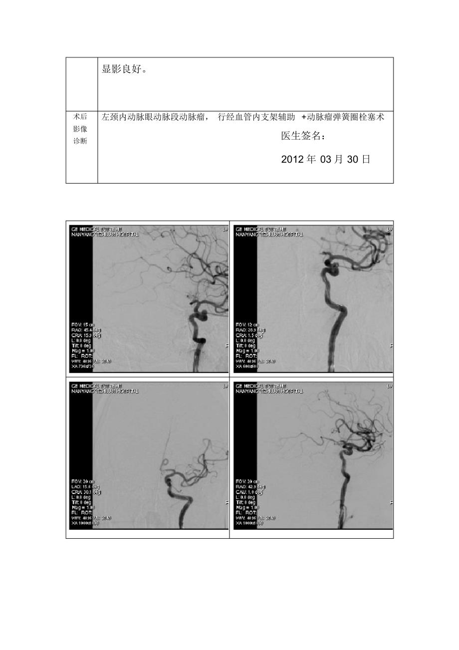 动脉瘤栓塞术报告单_3__第2页