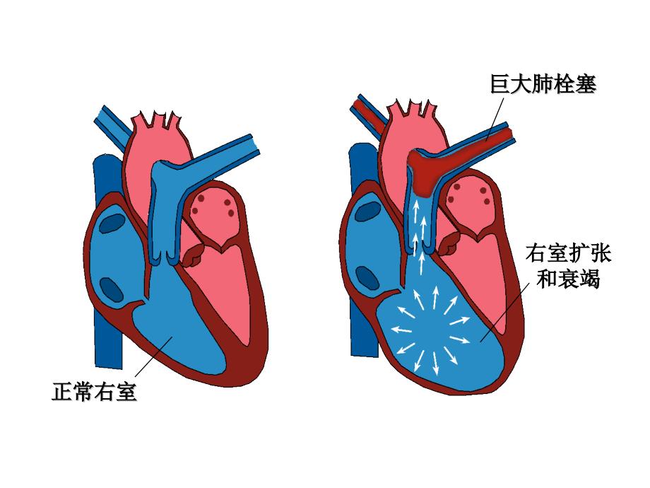 (ppt)-下肢深静脉血栓形成的危险因素和预防措施重庆市血管外科中_第4页
