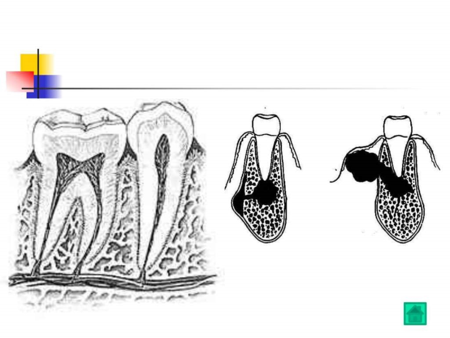 x牙髓病和根尖周病的治疗_第4页