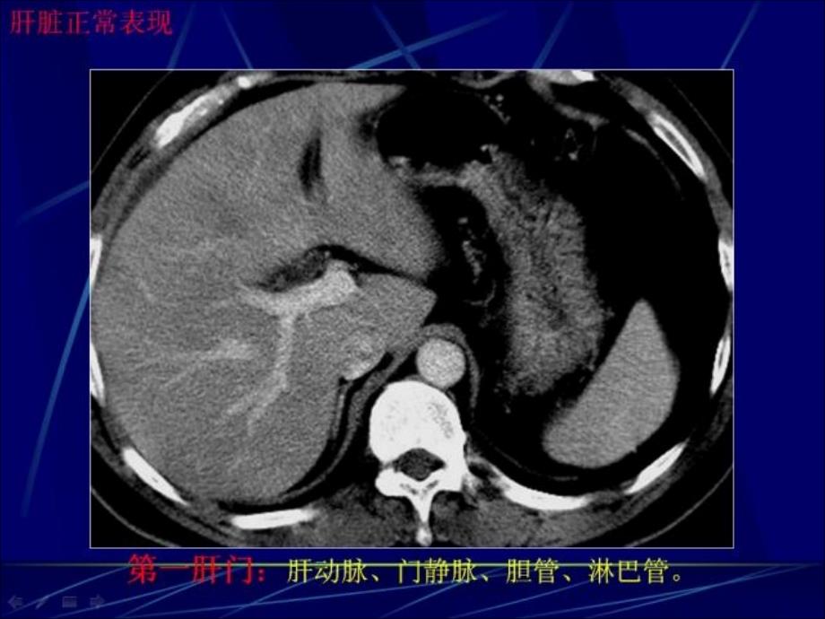 0018肝癌影像表现_第3页