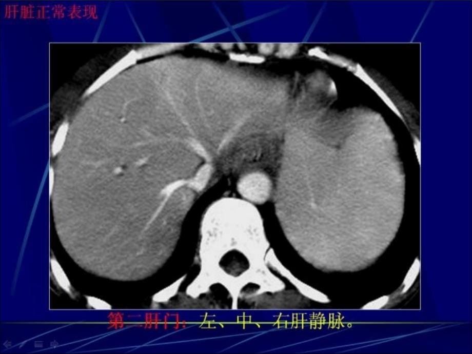 0018肝癌影像表现_第5页