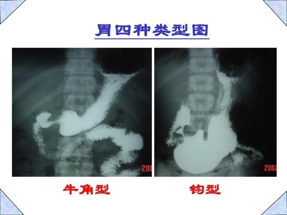 [资料]胃癌影像诊断_第5页