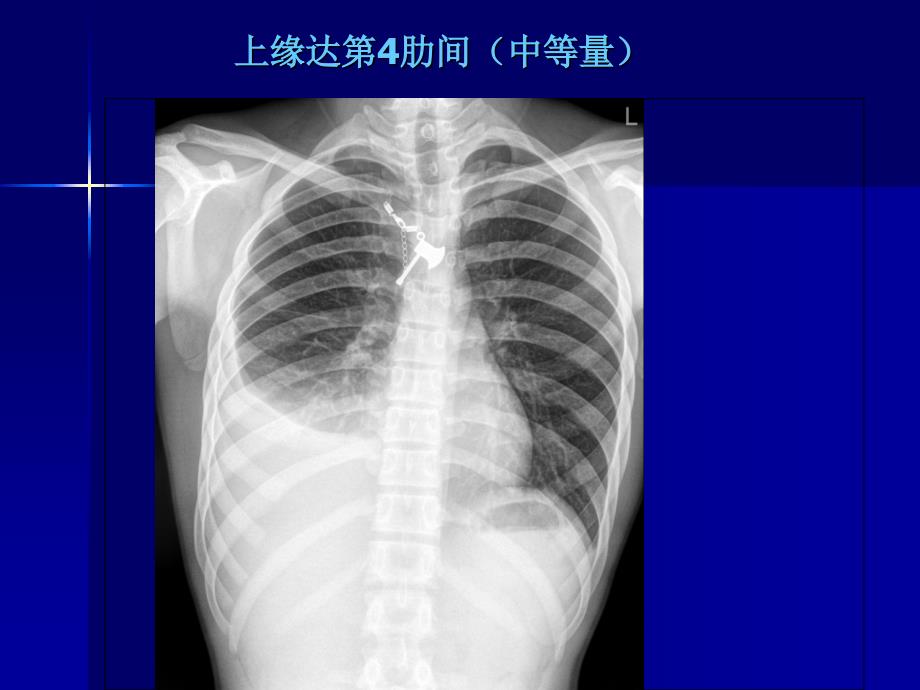 X线胸片阅读PPT课件_第4页