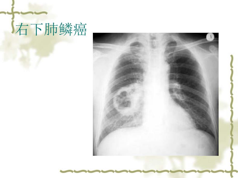 X线检查适应症ppt课件_第4页