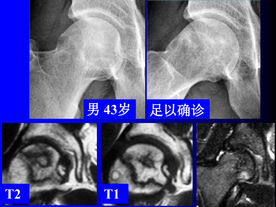 中西医结合医学影像学ppt课件股骨头坏死塌陷的影像临床病理学研究1_第3页