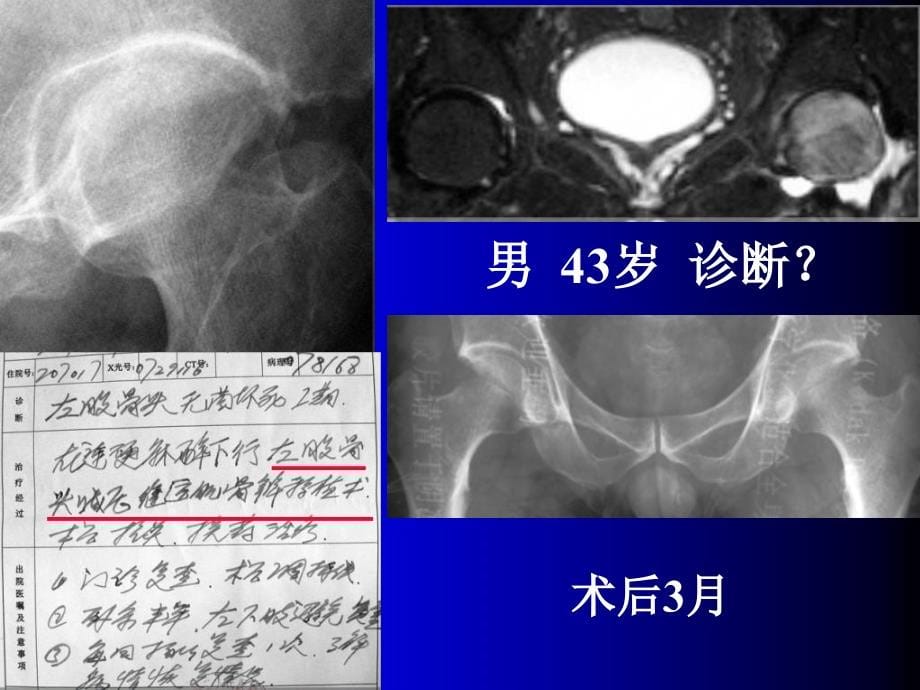 中西医结合医学影像学ppt课件股骨头坏死塌陷的影像临床病理学研究1_第5页