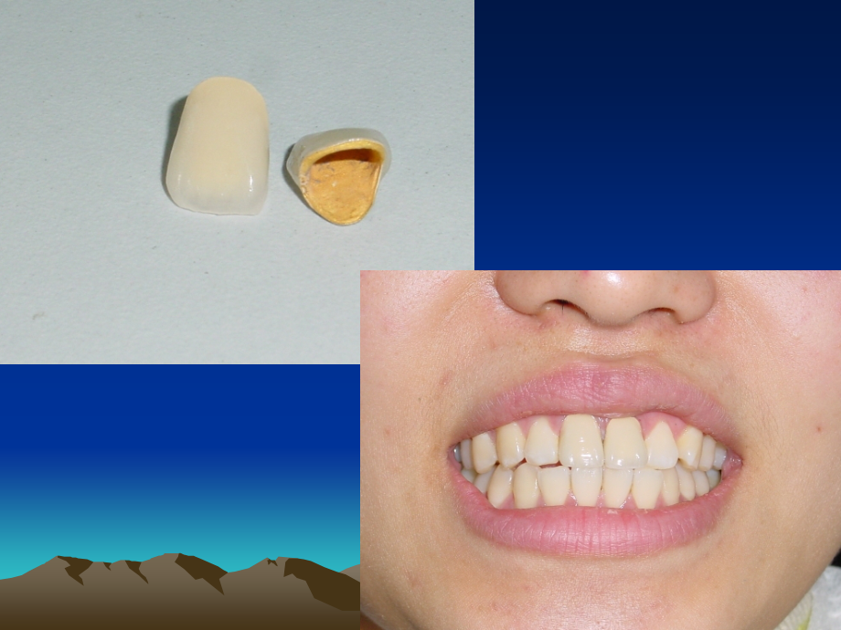牙体缺损的固定义齿修复(ppt-87)_第2页