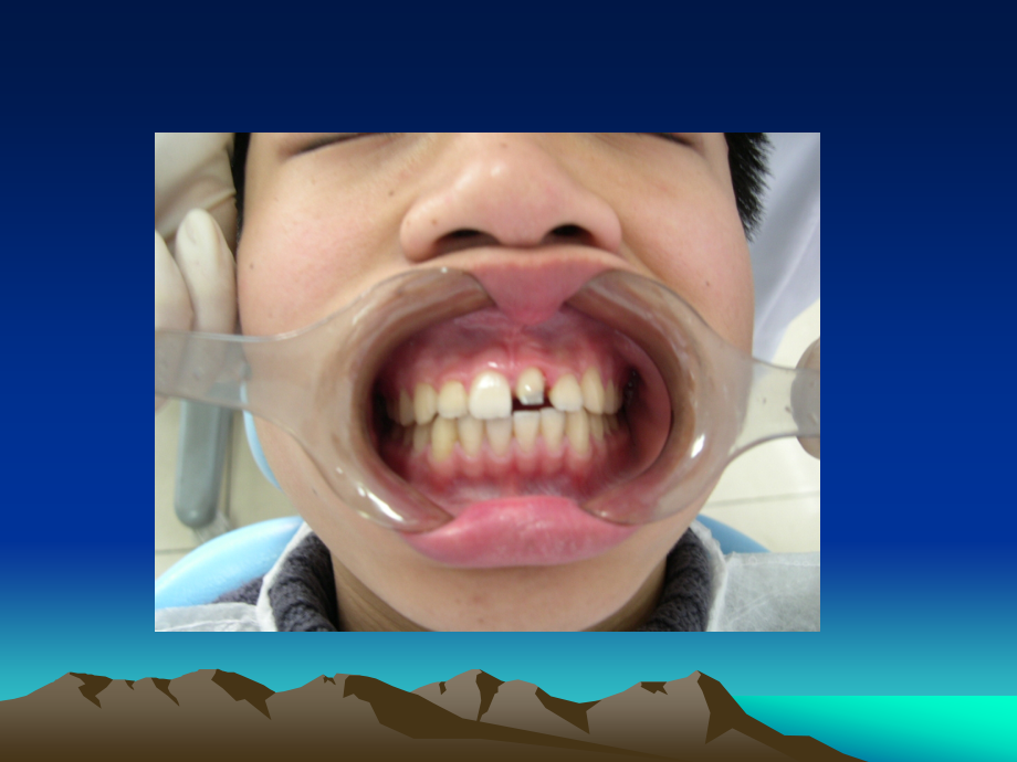 牙体缺损的固定义齿修复(ppt-87)_第4页