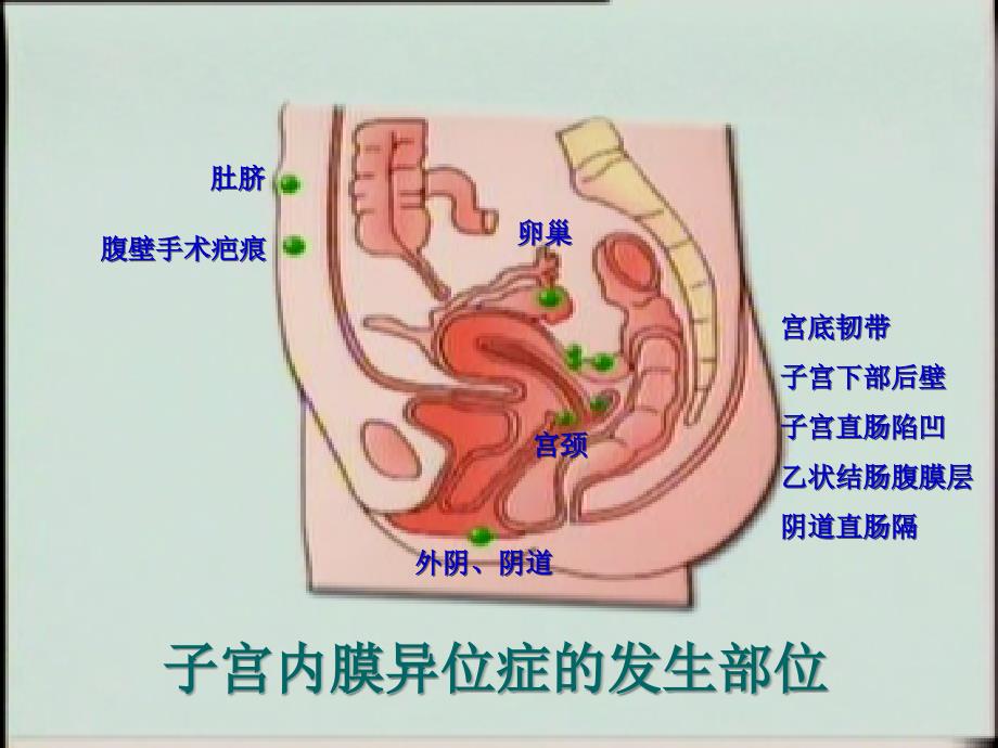 妇产科课件__子宫内膜异位症2009_第4页