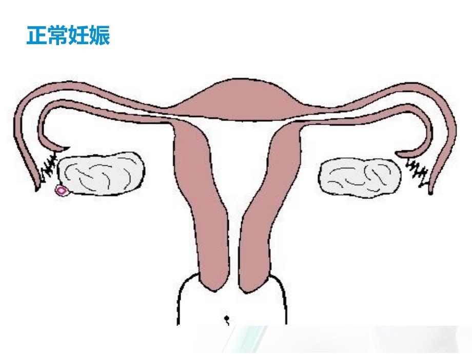 异位妊娠-ppt课件_第3页