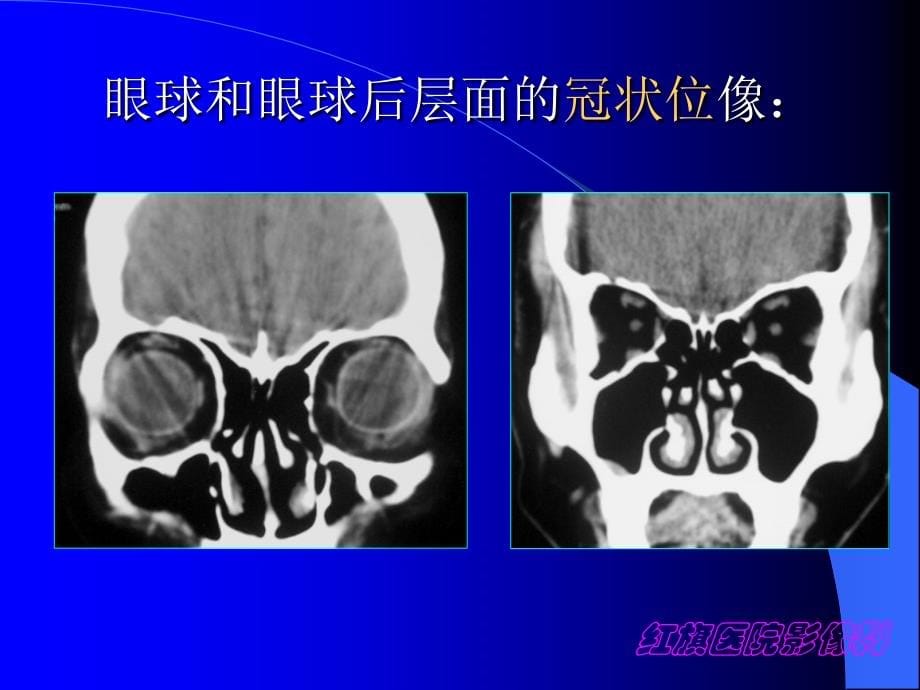 影像诊断课件-五官_第5页