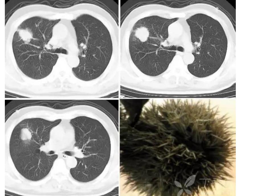 医学ppt肺部常见ct征象_第3页