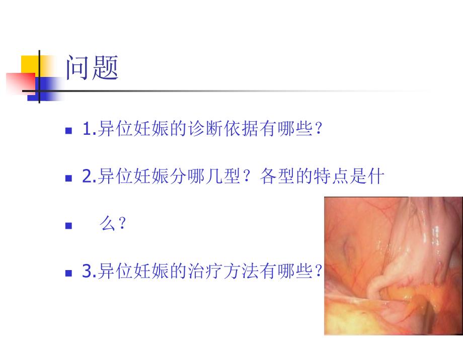 中医妇科课件异位妊娠_第2页
