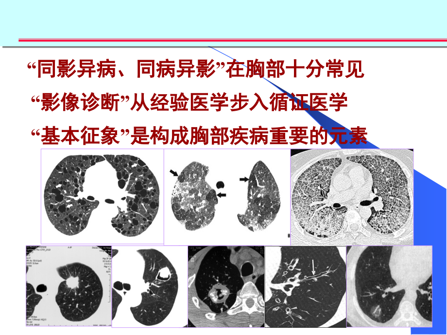 医学ppt肺部征象诊断应用_第2页