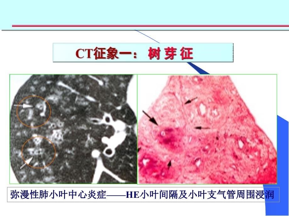 医学ppt肺部征象诊断应用_第5页