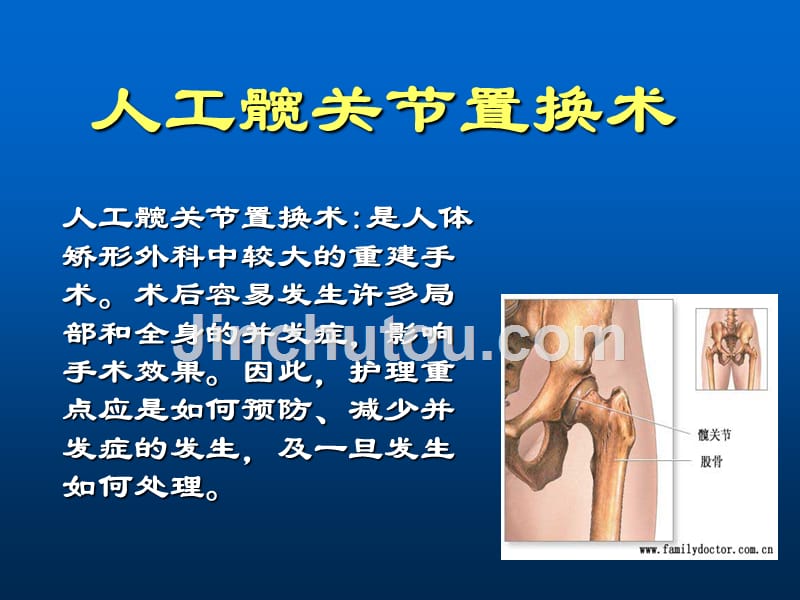 人工关节置换术护理ppt课件_第2页