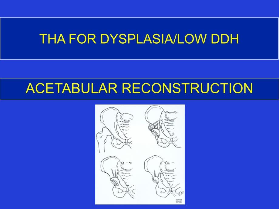 先天性髋关节脱位的髋关节置换ppt课件_第3页