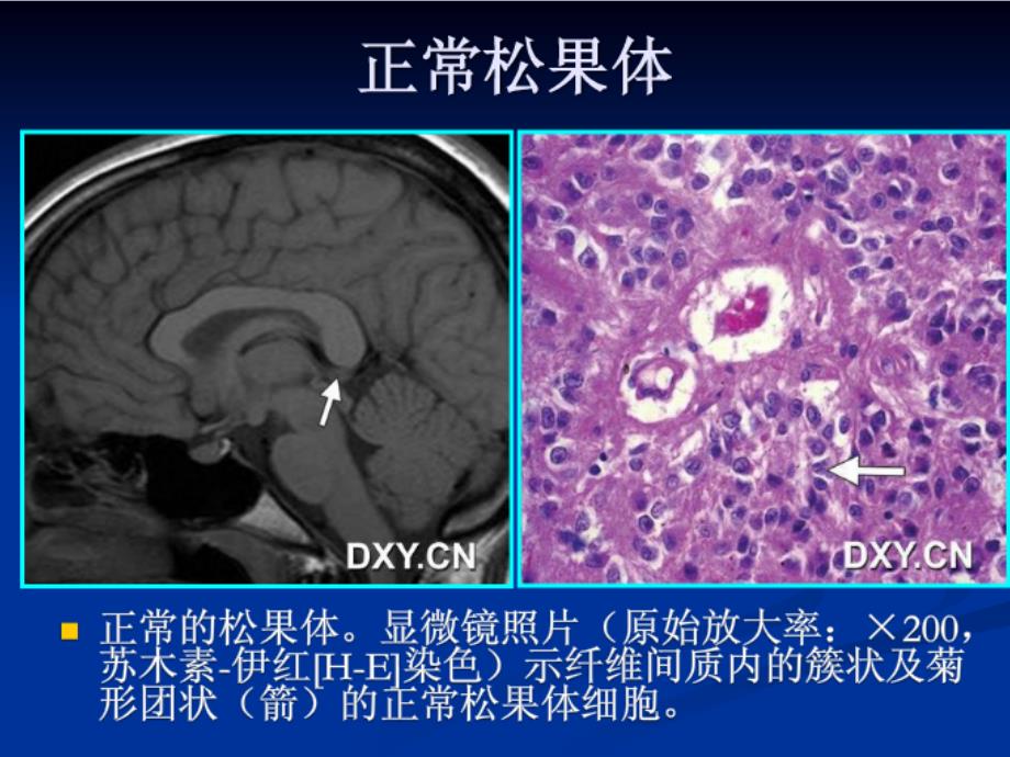 松果体细胞瘤ppt课件_第4页