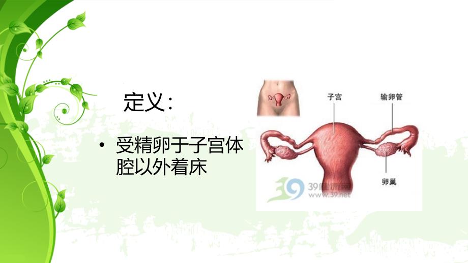 异位妊娠(课件)84262_第2页