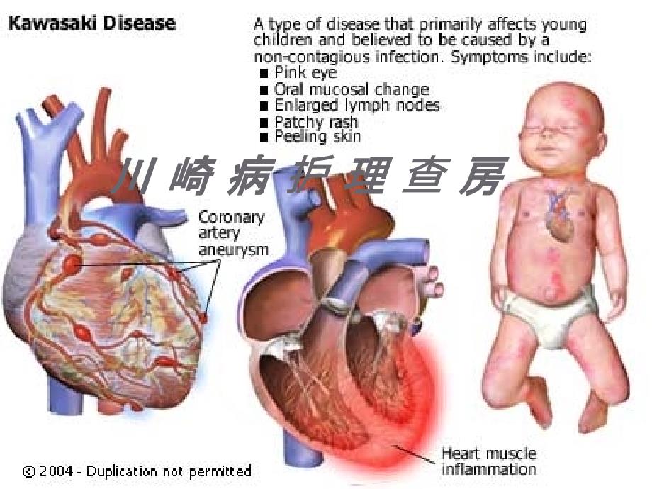 川崎病的护理查房医学 ppt课件_第1页