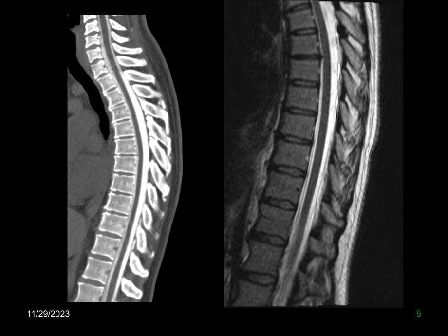 中枢脊柱课件_第5页