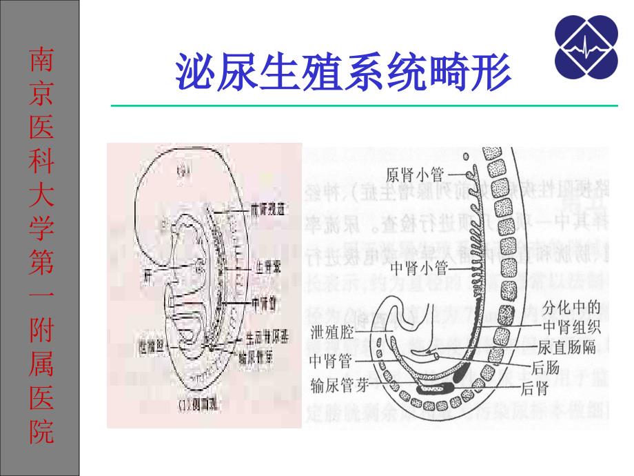 泌尿生殖系统畸形课件_第4页