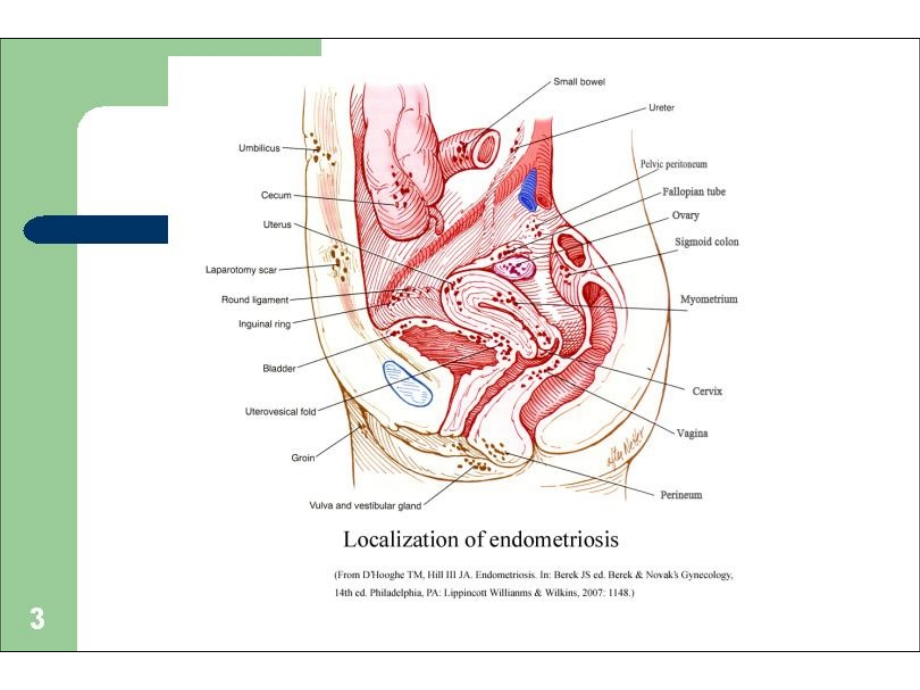 医学本科院校精品课件_子宫内膜异位症__第3页