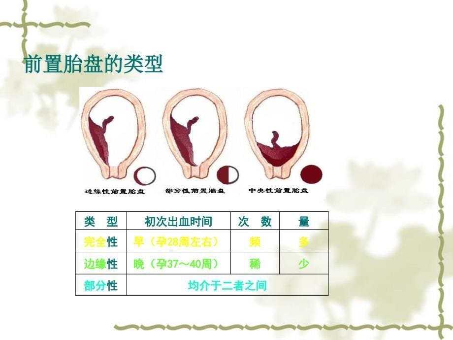 前置胎盘的护理查房课件_第5页