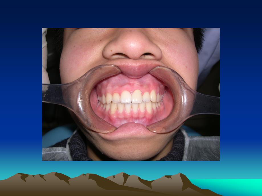 牙体缺损的固定义齿修复(ppt-87).ppt_第3页