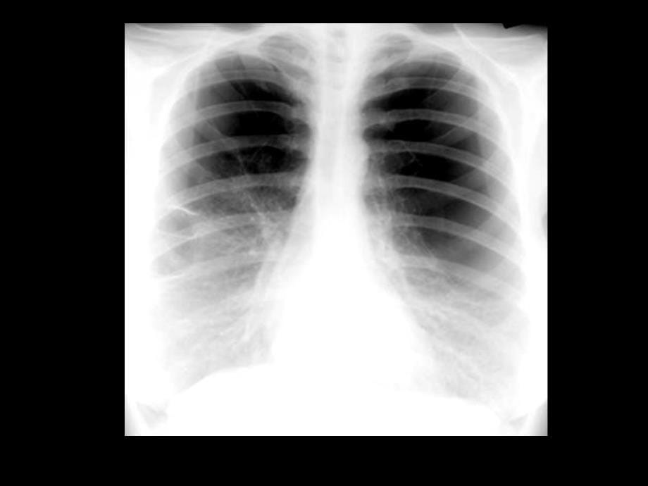 医学ppt呼吸系统基本病变影像学表现见习幻灯_第5页