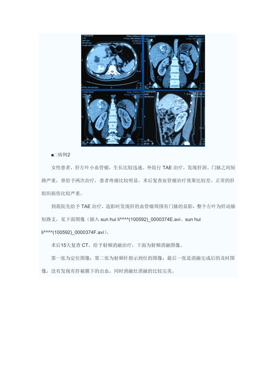 肝血管瘤与肝转移癌射频消融治疗_第4页