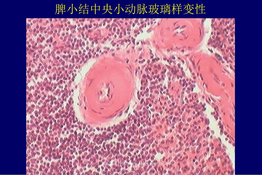 基础医学北大病理学ppt课件高血压_第4页