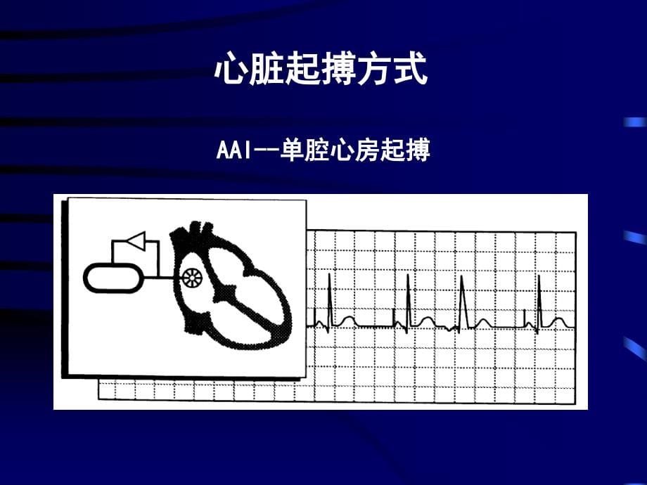 心脏起搏器适应证类型选择与应用万征心脏起搏与电生理学继 课件_3_第5页