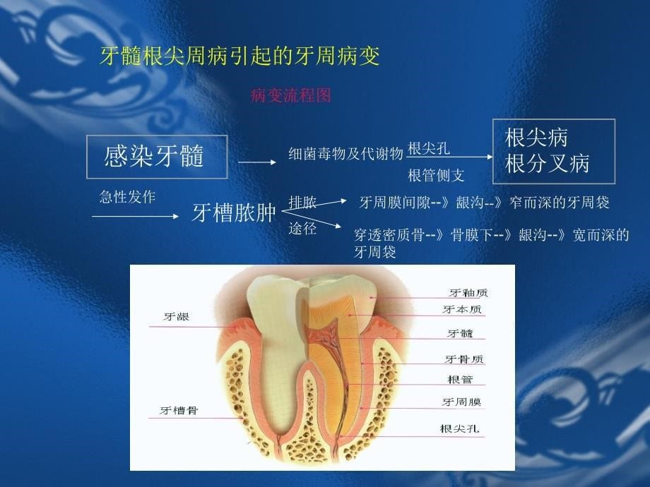 临床医学牙周炎的伴发病变课件_第5页