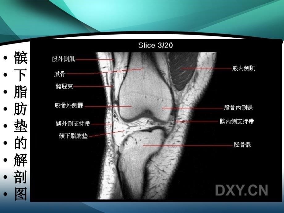 髌下脂肪垫损伤PPT课件_第5页