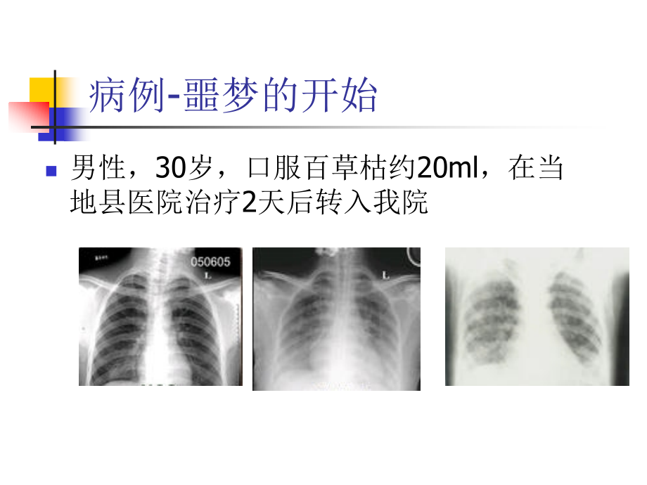 百草枯中毒PPT课件_第2页