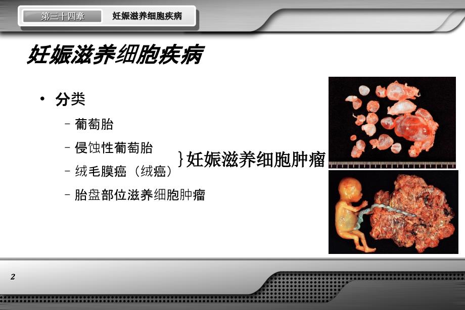 妇产科学妊娠滋养细胞疾病课件_第2页