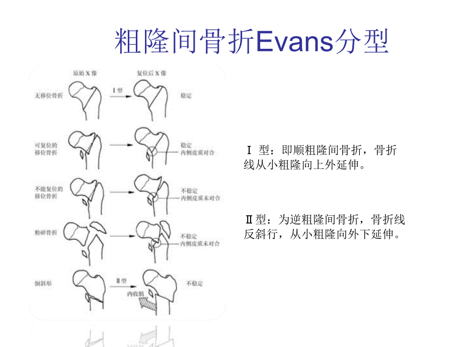 在股骨粗隆间骨折的应用摘要课件_第4页