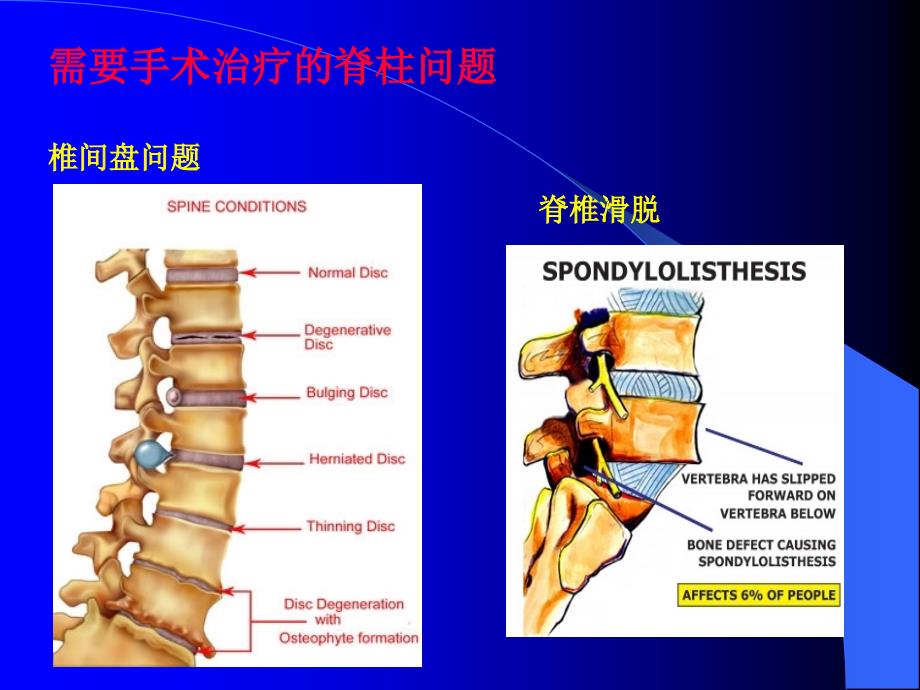 手术室护理查房脊柱手术的麻醉课件_第2页