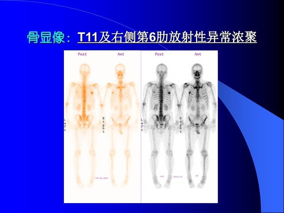 pet在淋巴瘤中的应用课件_第5页