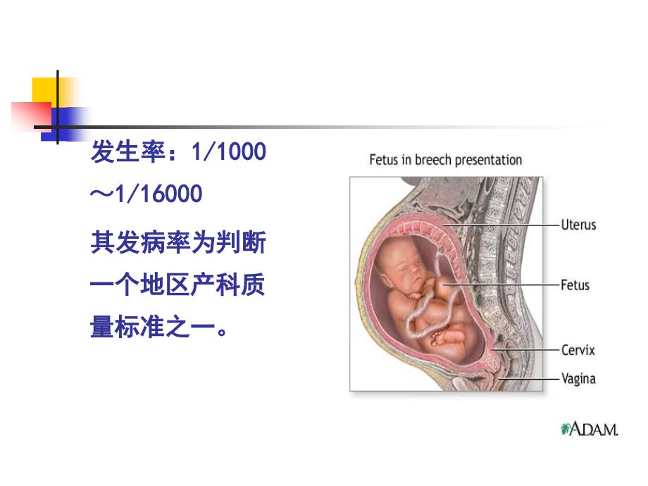 子宫破裂_12课件_第3页