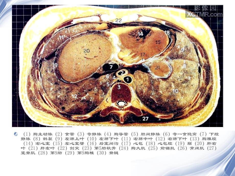人体断层解剖图谱腹腔_ppt课件_第3页