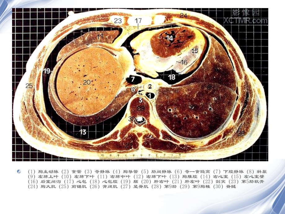 人体断层解剖图谱腹腔_ppt课件_第4页