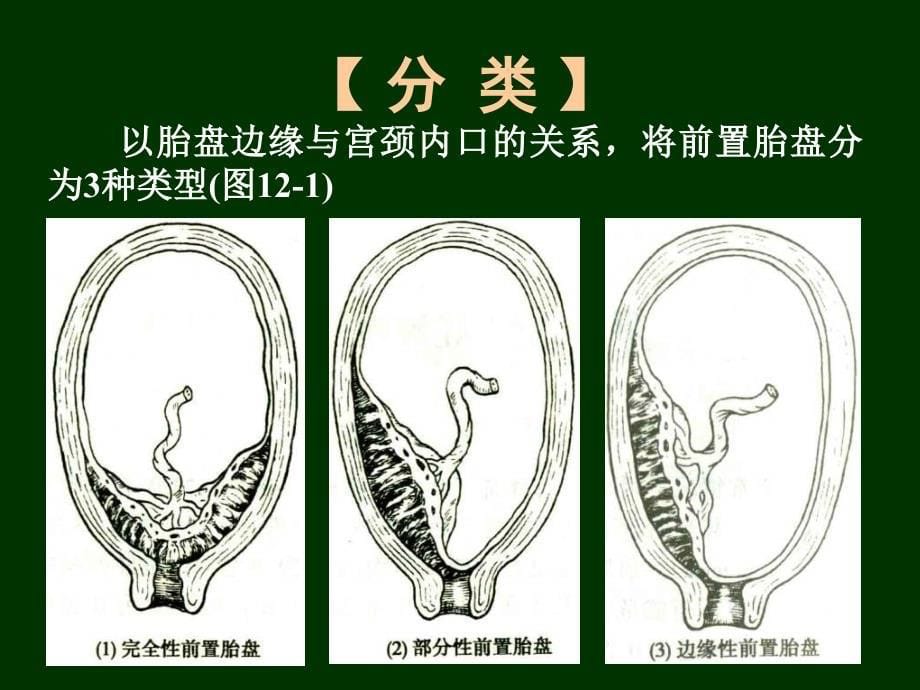 临床医学前置胎盘课件_第5页