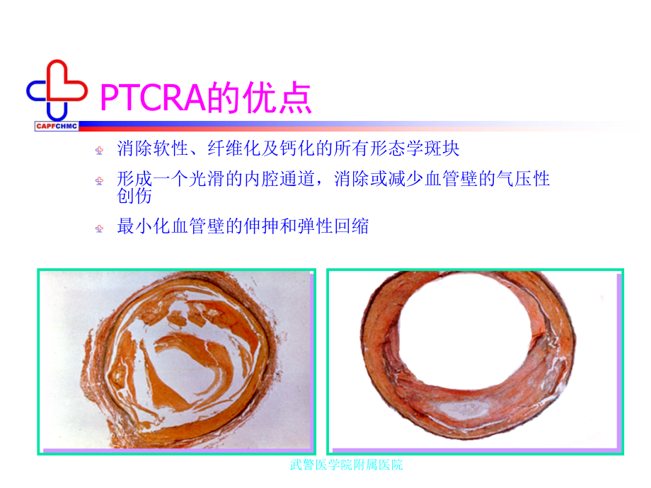 经皮冠状动脉腔内精品课件_第3页