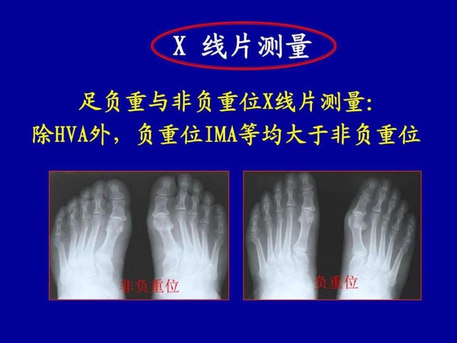 指拇外翻诊断图文课件_第3页