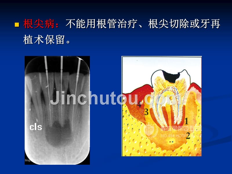 第六章拔牙术课件_第4页