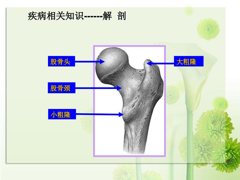 股骨间粗隆骨折护理查房课件_2_第4页