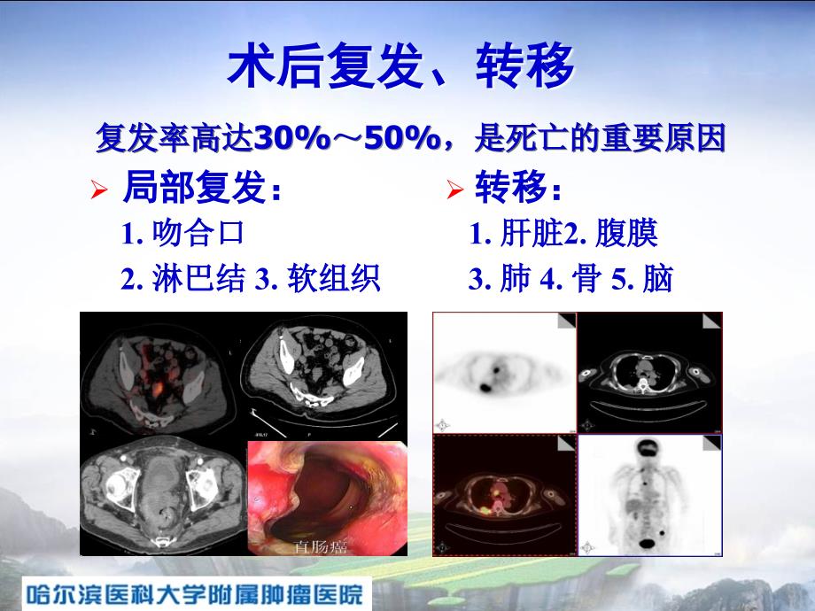 精品大肠癌微转移的实验研究及肝转移的外科治疗课件_第3页