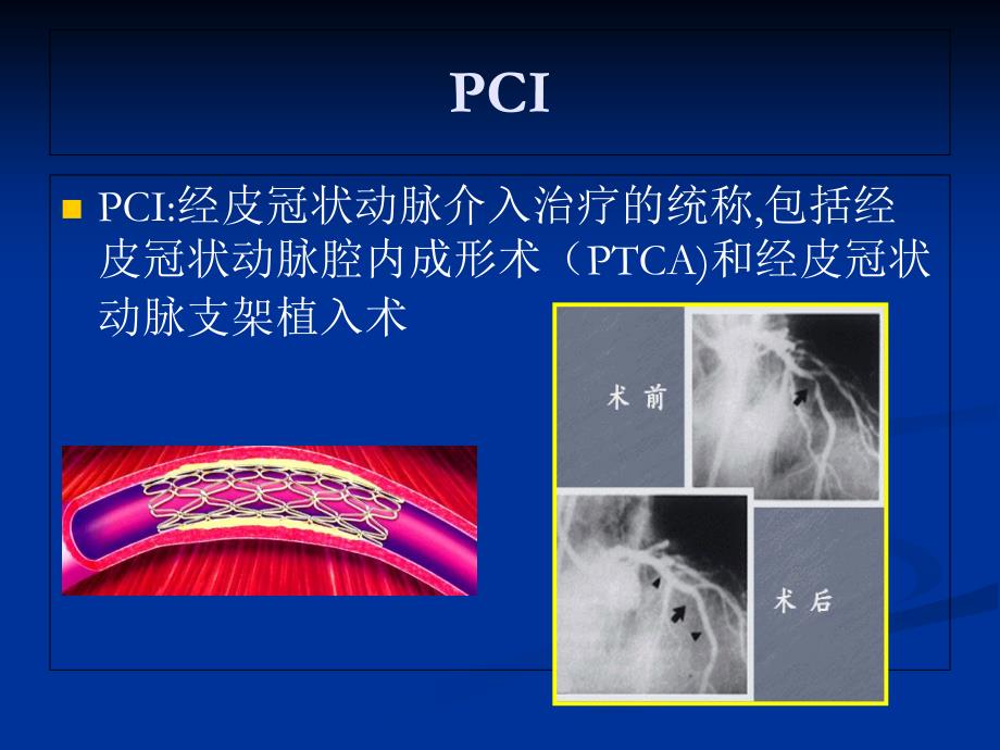 急性心肌梗死急诊PCI临床路径管理与护理_第2页